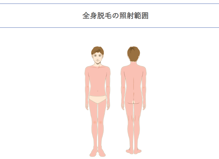札幌クララ美容皮膚科の全身脱毛の照射範囲
