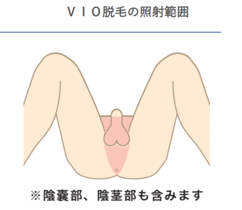 札幌クララ美容皮膚科 メンズ脱毛 VIO脱毛の照射範囲
