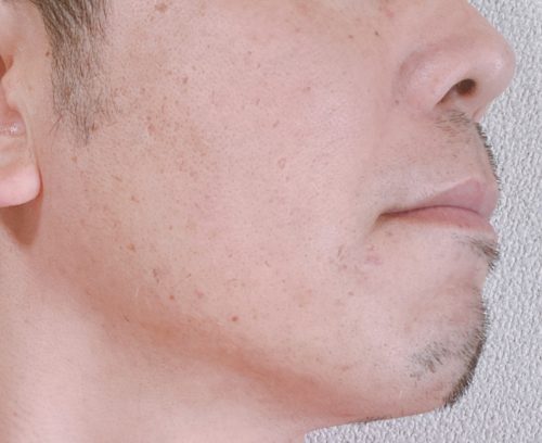 光照射後11週・1週間伸ばした状態の右ほほ