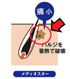 毛のバルジ領域を矢印で指す