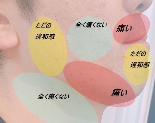 脱毛機の照射機をヒゲに当てたときの痛みの箇所を色分け