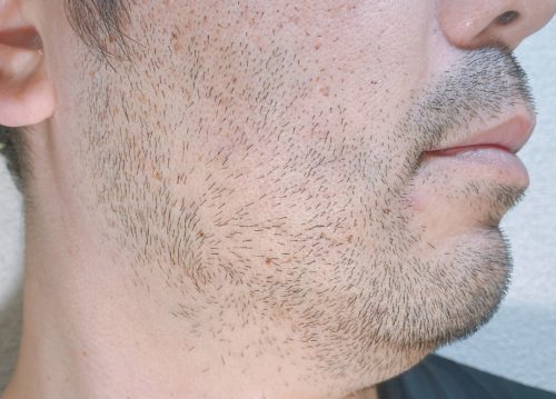 脱毛前1週間、ヒゲを伸ばした状態の右ほほ