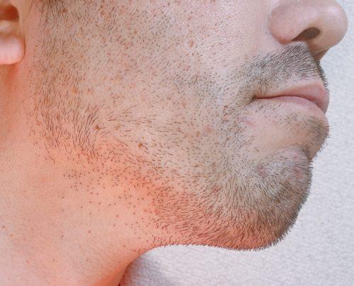 男性の右頬のヒゲが伸びた写真