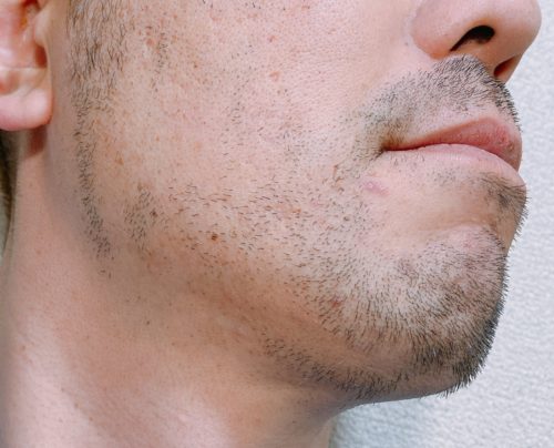 男性の脱毛後3週間が経過した左ホホヒゲ
