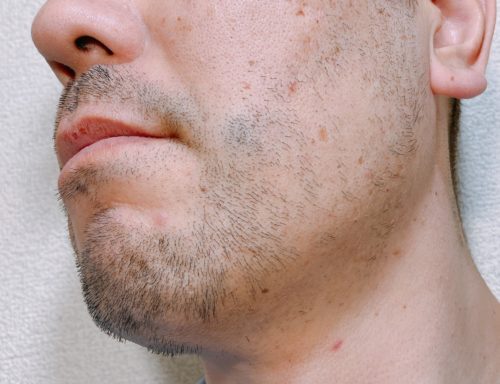 男性の左頬のヒゲが伸びた写真