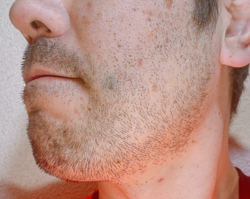 男性の左頬のヒゲが伸びた写真