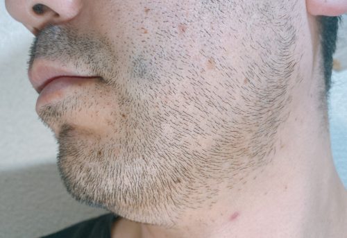 男性の左頬のヒゲが伸びた写真