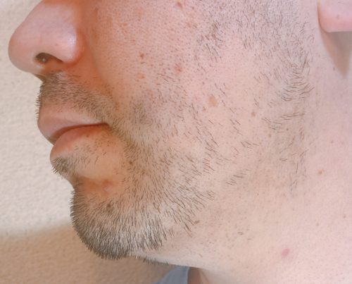 男性の左頬のヒゲが伸びた写真